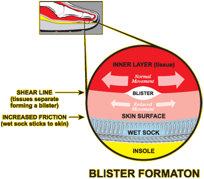 http://www.drymaxsocks.com/images/blister_formation.gif