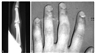 Growth Plate Stress Fractures in Teenage Climbers
