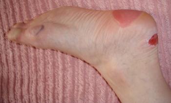 back of heel blister treatment